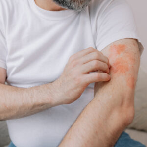 3 ways for managing eczema symptoms